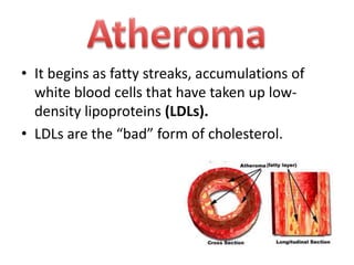 • It begins as fatty streaks, accumulations of
white blood cells that have taken up lowdensity lipoproteins (LDLs).
• LDLs are the “bad” form of cholesterol.

 