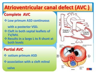 ANESTHESIA FOR CONGENITAL HEART DISEASES | PPTX