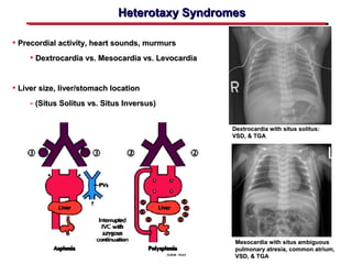 congenital-heart-disease-screening-in-the-neonate-ppt