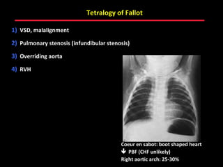 Tetralogy of Fallot

1) VSD, malalignment
2) Pulmonary stenosis (infundibular stenosis)
3) Overriding aorta
4) RVH




                                            Coeur en sabot: boot shaped heart
                                             PBF (CHF unlikely)
                                   ABB MD   Right aortic arch: 25-30%
 