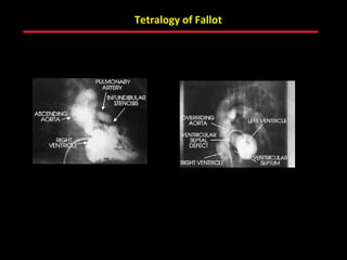 Tetralogy of Fallot




      ABB MD
 