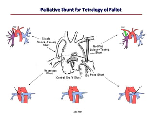 Palliative Shunt for Tetralogy of Fallot




                ABB MD
 