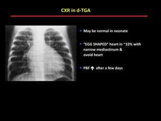 CXR in d-TGA


        • May be normal in neonate

        • “EGG SHAPED” heart in ~33% with
          narrow mediastinum &
          ovoid heart


        • PBF  after a few days




      ABB MD
 