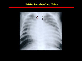 d-TGA: Portable Chest X-Ray




           ABB MD
 