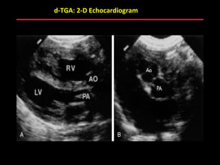 d-TGA: 2-D Echocardiogram




              ABB MD
 