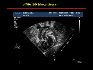 d-TGA: 2-D Echocardiogram




              ABB MD
 