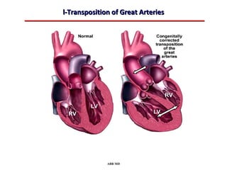 l-Transposition of Great Arteries




              ABB MD
 