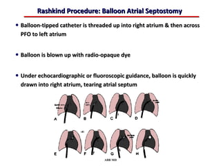 Rashkind Procedure: Balloon Atrial Septostomy
• Balloon-tipped catheter is threaded up into right atrium & then across
  PFO to left atrium


• Balloon is blown up with radio-opaque dye

• Under echocardiographic or fluoroscopic guidance, balloon is quickly
  drawn into right atrium, tearing atrial septum




                                  ABB MD
 