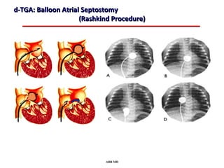 d-TGA: Balloon Atrial Septostomy
                     (Rashkind Procedure)




                            ABB MD
 