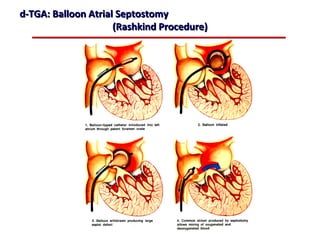 d-TGA: Balloon Atrial Septostomy
                     (Rashkind Procedure)




                            ABB MD
 