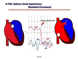 d-TGA: Balloon Atrial Septostomy
                     (Rashkind Procedure)




                                  Balloon rupture of IAS



                          RAP




                            LAP           RAP




                                        LAP




                            ABB MD
 