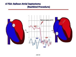 d-TGA: Balloon Atrial Septostomy
                     (Rashkind Procedure)




                          LAP




                            RAP        LAP




                                     RAP




                            ABB MD
 