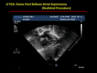 d-TGA: Status Post Balloon Atrial Septostomy
                          (Rashkind Procedure)




                            ABB MD
 