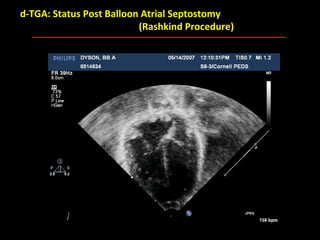 d-TGA: Status Post Balloon Atrial Septostomy
                          (Rashkind Procedure)




                            ABB MD
 