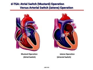 d-TGA: Atrial Switch (Mustard) Operation
      Versus Arterial Switch (Jatene) Operation




       Mustard Operation               Jatene Operation
         (Atrial Switch)            (Arterial Switch)



                           ABB MD
 