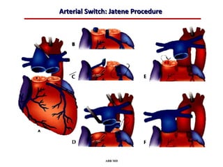 Arterial Switch: Jatene Procedure




              ABB MD
 