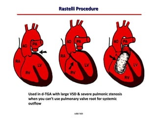 Rastelli Procedure




Used in d-TGA with large VSD & severe pulmonic stenosis
when you can’t use pulmonary valve root for systemic
outflow

                          ABB MD
 