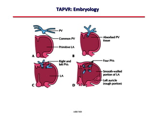 TAPVR: Embryology




      ABB MD
 