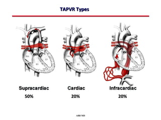 TAPVR Types




50%       20%        20%


            ABB MD
 