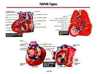 TAPVR Types




    ABB MD
 