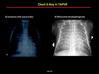 Chest X-Ray in TAPVR


A) Snowman with supracardiac                 B) Obstructed infradiaphragmatic




 A                                           B




                                    ABB MD
 