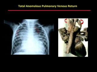 Total Anomalous Pulmonary Venous Return




                  ABB MD
 