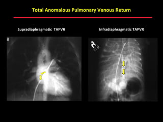 Total Anomalous Pulmonary Venous Return


Supradiaphragmatic TAPVR            Infradiaphragmatic TAPVR




                           ABB MD
 
