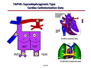 TAPVR: Supradiaphragmatic Type
          Cardiac Catheterization Data




                                   To SVC in anterior view




                                   To left SVC in posterior view

                      ABB MD
 