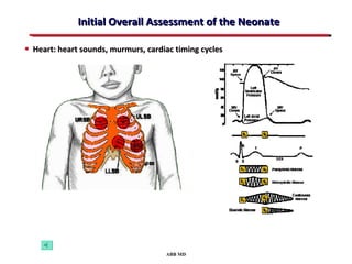 Initial Overall Assessment of the Neonate

• Heart: heart sounds, murmurs, cardiac timing cycles




                                     ABB MD
 