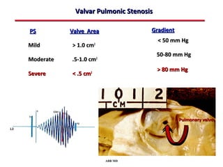 Valvar Pulmonic Stenosis

PS         Valve Area                  Gradient
                                         < 50 mm Hg
Mild       > 1.0 cm   2


                                        50-80 mm Hg
Moderate   .5-1.0 cm      2


                                        > 80 mm Hg
Severe     < .5 cm2




                                                  Pulmonary valve




                              ABB MD
 