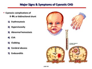 Major Signs & Symptoms of Cyanotic CHD

• Cyanosis: complications of
      R  L or bidirectional shunt

    1) Erythrocytosis

    2) Hyperviscosity

    3) Abnormal hemostasis

    4) CVA

    5) Clubbing

    6) Cerebral abscess

    7) Endocarditis




                                     ABB MD
 