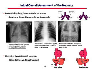 Initial Overall Assessment of the Neonate

• Precordial activity, heart sounds, murmurs
     - Dextrocardia vs. Mesocardia vs. Levocardia




      Dextrocardia with situs inversus   Mesocardia & situs inversus (right-   Mesocardia with situs ambiguous:
      mirror image dextrocardia:         sided stomach bubble): DORV, AV       pulmonary atresia, common atrium,
      no congenital heart disease        canal, PS, & asplenia                 VSD, & TGA




• Liver size, liver/stomach location
     - (Situs Solitus vs. Situs Inversus)

                                                      ABB MD
 