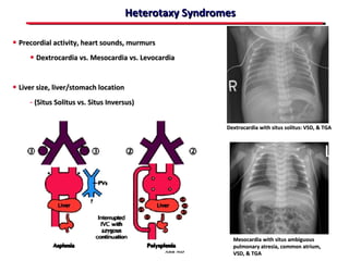 Heterotaxy Syndromes

• Precordial activity, heart sounds, murmurs
     • Dextrocardia vs. Mesocardia vs. Levocardia


• Liver size, liver/stomach location
     - (Situs Solitus vs. Situs Inversus)

                                                         Dextrocardia with situs solitus: VSD, & TGA




                                                           Mesocardia with situs ambiguous
                                                           pulmonary atresia, common atrium,
                                               ABB MD      VSD, & TGA
 