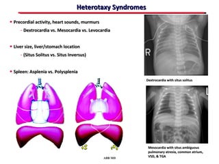 Heterotaxy Syndromes
• Precordial activity, heart sounds, murmurs
     - Dextrocardia vs. Mesocardia vs. Levocardia

• Liver size, liver/stomach location
      - (Situs Solitus vs. Situs Inversus)

• Spleen: Asplenia vs. Polysplenia
                                                           Dextrocardia with situs solitus




                                                            Mesocardia with situs ambiguous
                                                            pulmonary atresia, common atrium,
                                             ABB MD
                                                            VSD, & TGA
 