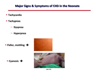 Major Signs & Symptoms of CHD in the Neonate

• Tachycardia
• Tachypnea
    – Dyspnea
    – Hyperpnea


• Pallor, mottling 




 • Cyanosis 

                            ABB MD
 