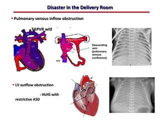 Disaster in the Delivery Room

• Pulmonary venous inflow obstruction

          - TAPVR with obstruction


                                          Descending
                                          vein
                                          (pulmonary
                                          venous
                                          confluence)




• LV outflow obstruction

                 - HLHS with
  restrictive ASD


                                 ABB MD
 