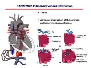 TAPVR With Pulmonary Venous Obstruction

              • TAPVR

              • Atresia or obstruction of the common
                pulmonary venous confluence




                  ABB MD
 
