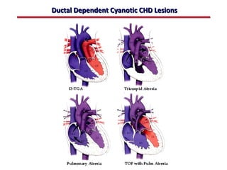 Ductal Dependent Cyanotic CHD Lesions




                ABB MD
 
