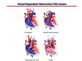 Ductal Dependent Obstructive CHD Lesions




                 ABB MD
 