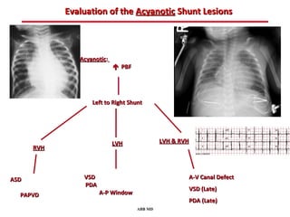 Evaluation of the Acyanotic Shunt Lesions



               Acyanotic:
                             PBF




                   Left to Right Shunt




                            LVH              LVH & RVH
      RVH



ASD             VSD                                  A-V Canal Defect
                PDA
                                                     VSD (Late)
  PAPVD               A-P Window
                                                     PDA (Late)
                                    ABB MD
 