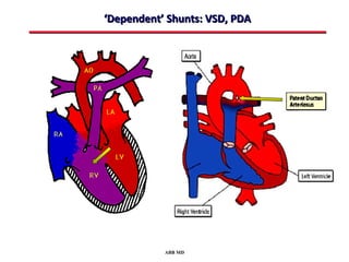 ‘Dependent’ Shunts: VSD, PDA




           ABB MD
 