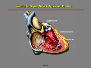 Ventricular Septal Defect: Types and Position




                                                r




                     ABB MD
 
