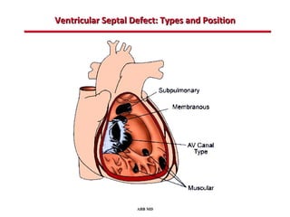 Ventricular Septal Defect: Types and Position




                    ABB MD
 