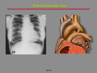 Patent Ductus Arteriosus




        ABB MD
 