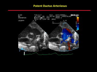 Patent Ductus Arteriosus




        ABB MD
 