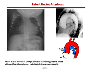 Patent Ductus Arteriosus




Patent ductus arteriosus (PDA) is common in the very preterm infant
with significant lung disease; radiological signs are non-specific
                                           ABB MD
 