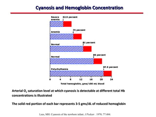 Cyanosis and Hemoglobin Concentration




Arterial O2 saturation level at which cyanosis is detectable at different total Hb
concentrations is illustrated

The solid red portion of each bar represents 3-5 gms/dL of reduced hemoglobin

                   Lees, MH. Cyanosis of the newborn infant. J Pediatr . 1970; 77:484.
 
