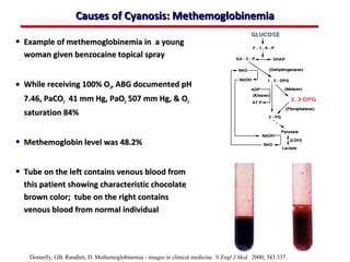 Causes of Cyanosis: Methemoglobinemia

• Example of methemoglobinemia in a young
  woman given benzocaine topical spray


• While receiving 100% O2, ABG documented pH
  7.46, PaCO2 41 mm Hg, PaO2 507 mm Hg, & O2
  saturation 84%


• Methemoglobin level was 48.2%

• Tube on the left contains venous blood from
  this patient showing characteristic chocolate
  brown color; tube on the right contains
  venous blood from normal individual




   Donnelly, GB, Randlett, D. Methemoglobinemia - images in clinical medicine. N Engl J Med. 2000; 343:337.
 