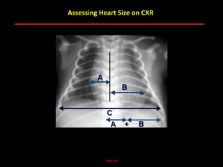 Assessing Heart Size on CXR




           ABB MD
 