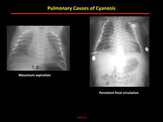 Pulmonary Causes of Cyanosis




Meconium aspiration



                                     Persistent fetal circulation




                            ABB MD
 
